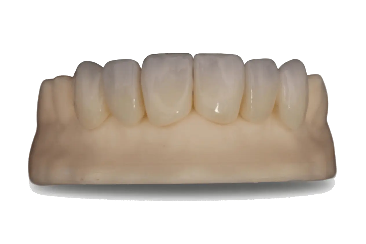 Carillas dentales