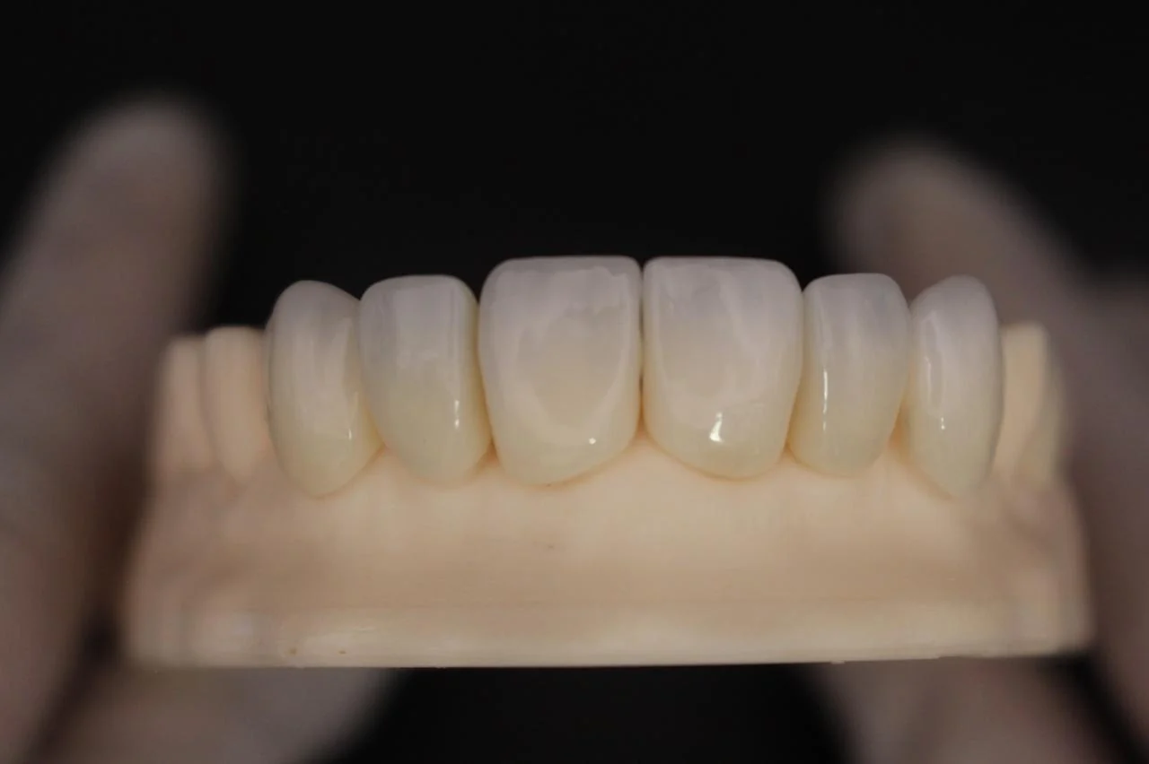 Carilla en disilicato sobre modelo, vista frontal
