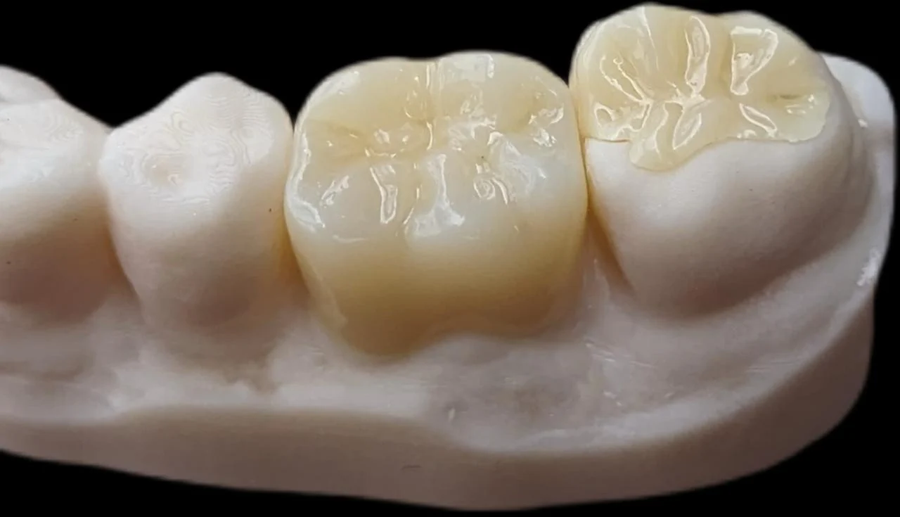 Corona de zirconio en el modelo