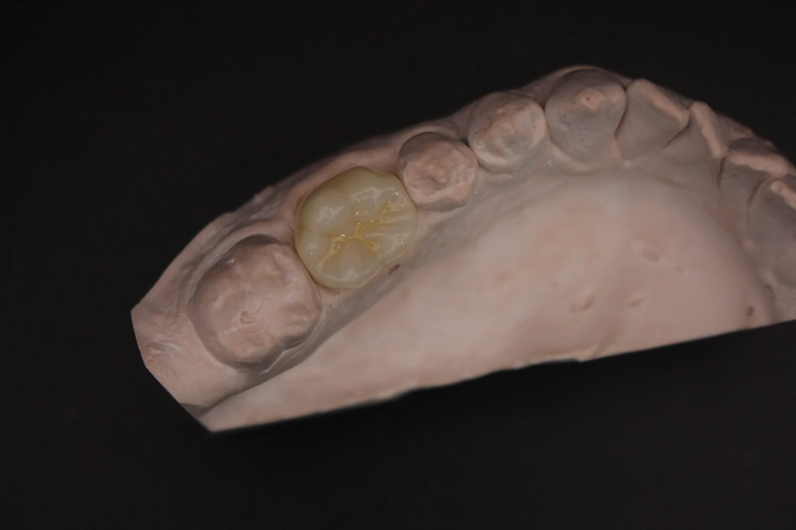 Corona de zirconio vista oclusal sobre el modelo