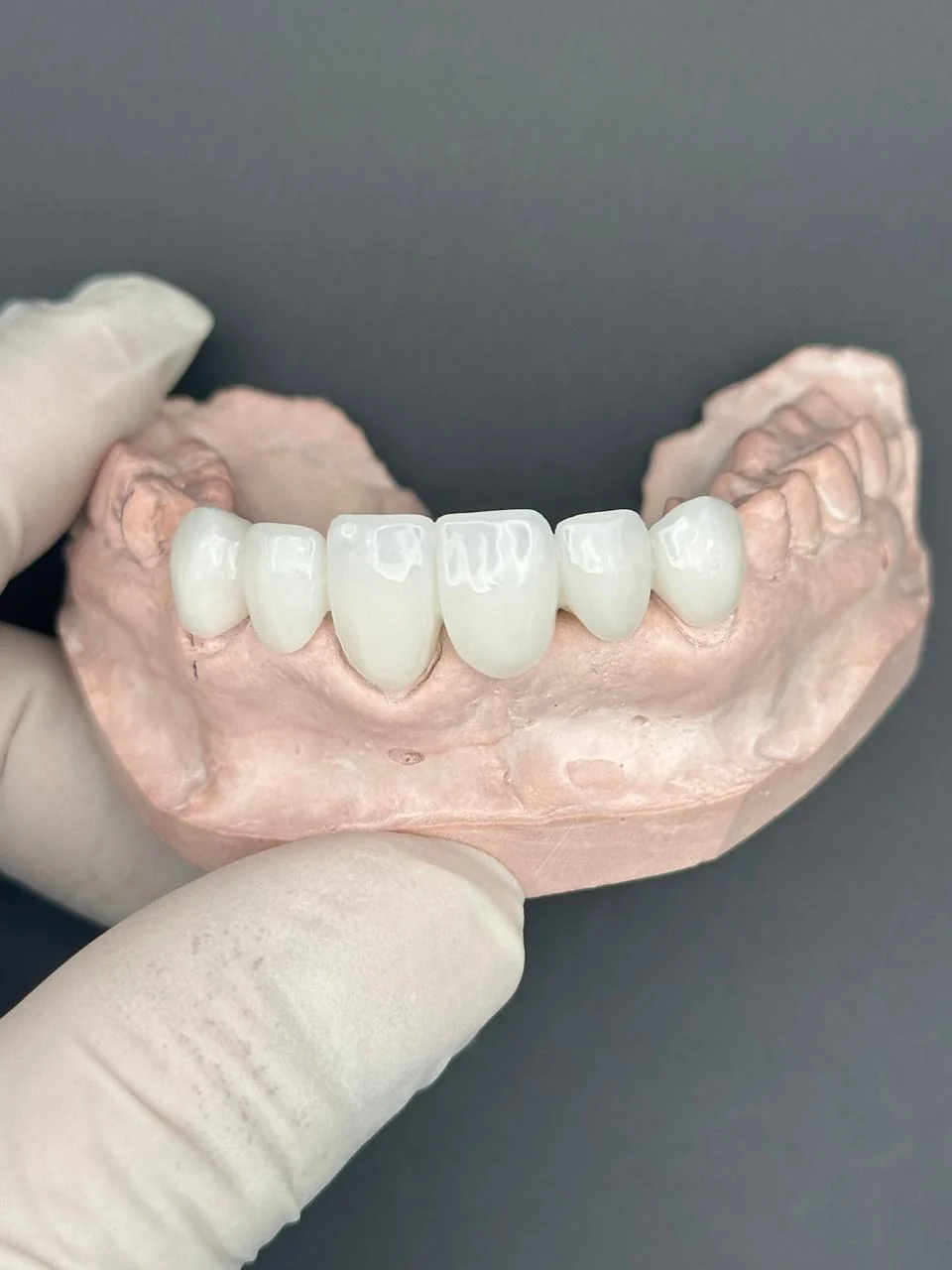 Puente de zirconio sobre el modelo