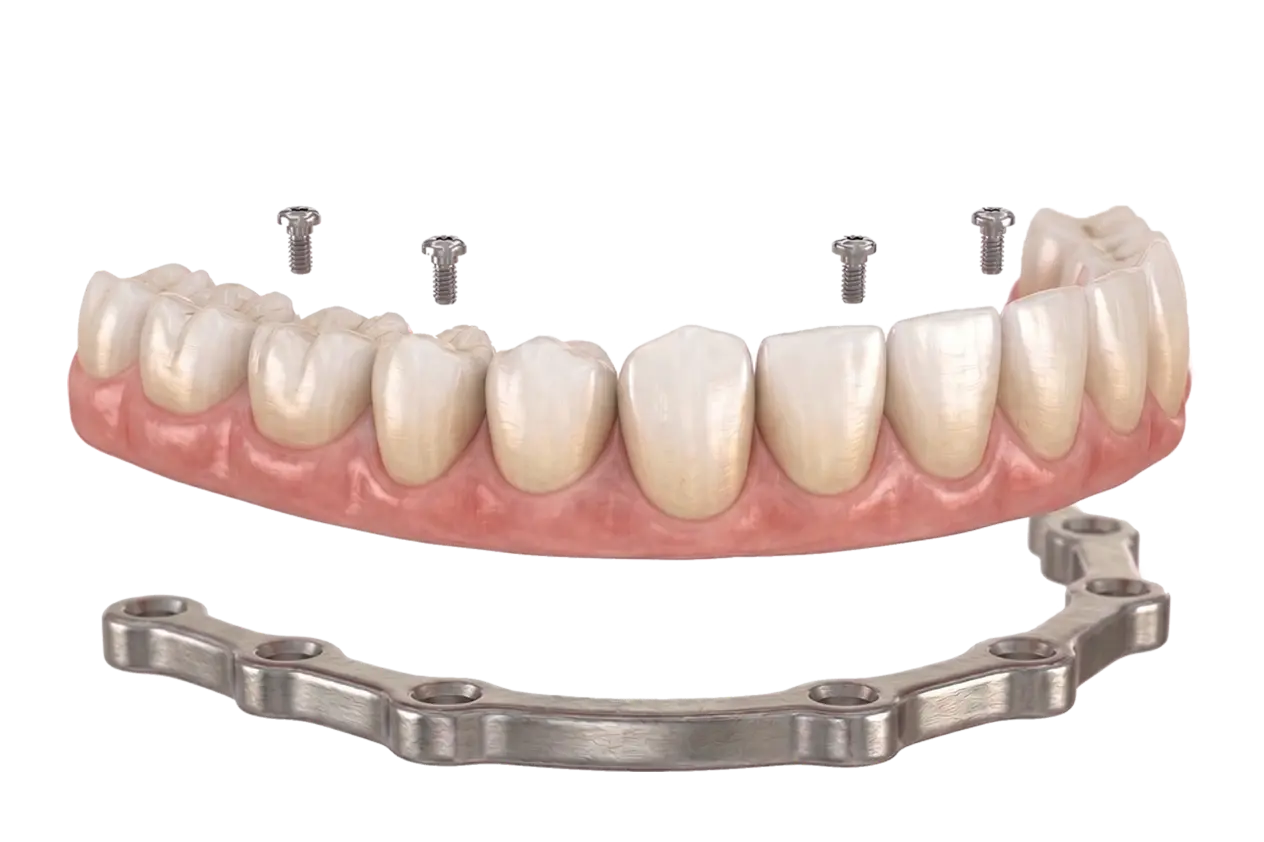 Puentes dentales