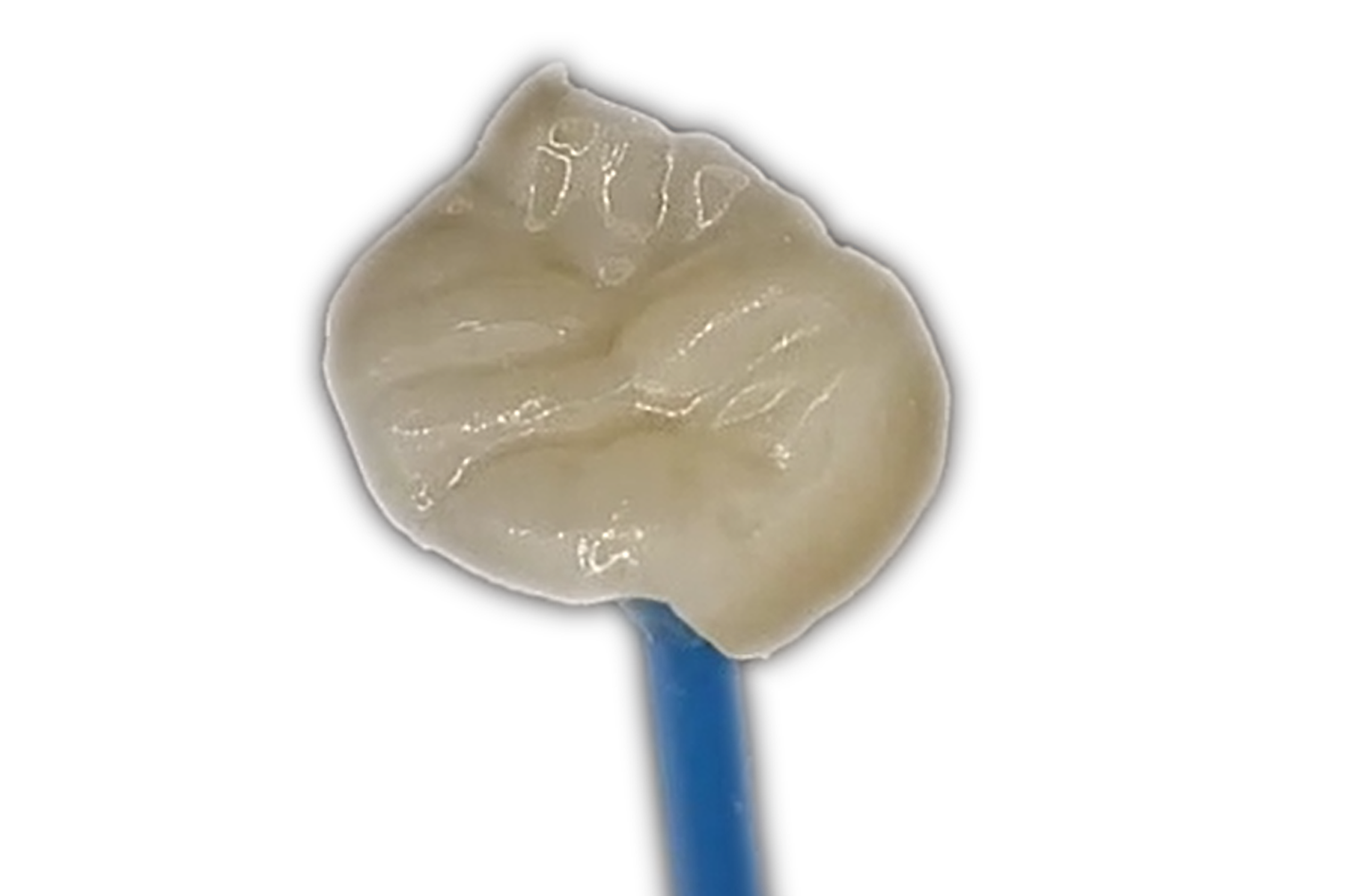 Incrustaciones dentales