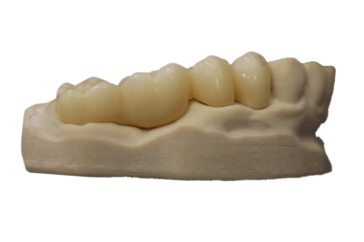 Puentes dentales